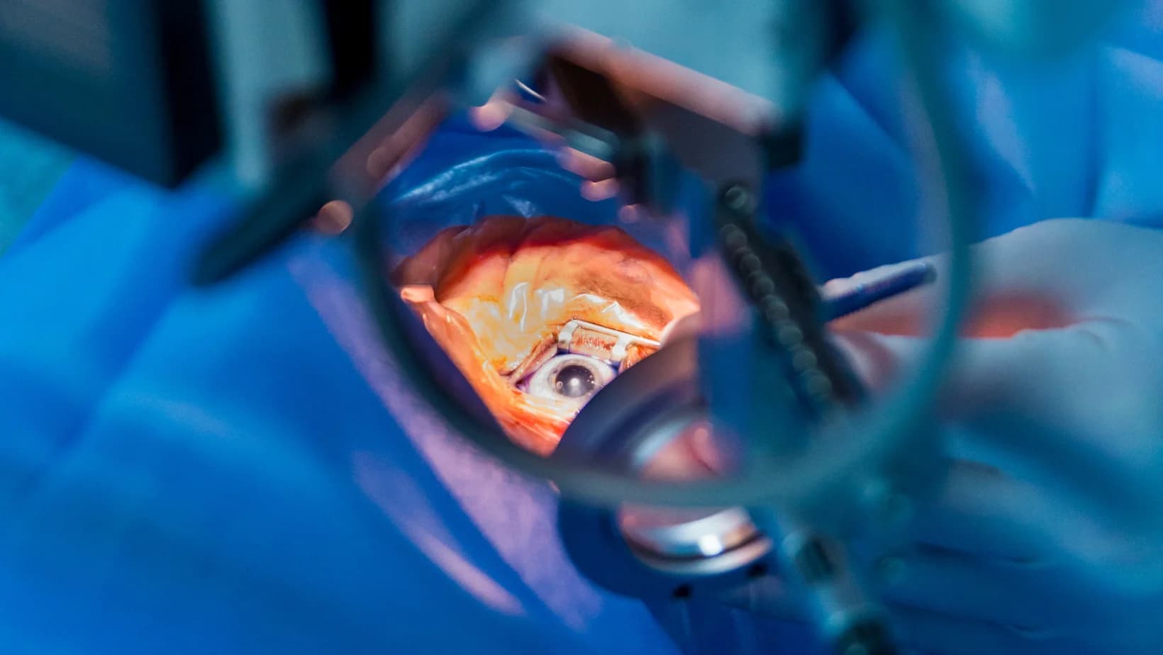 Ce este vitrectomia si cand este necesara interventia?