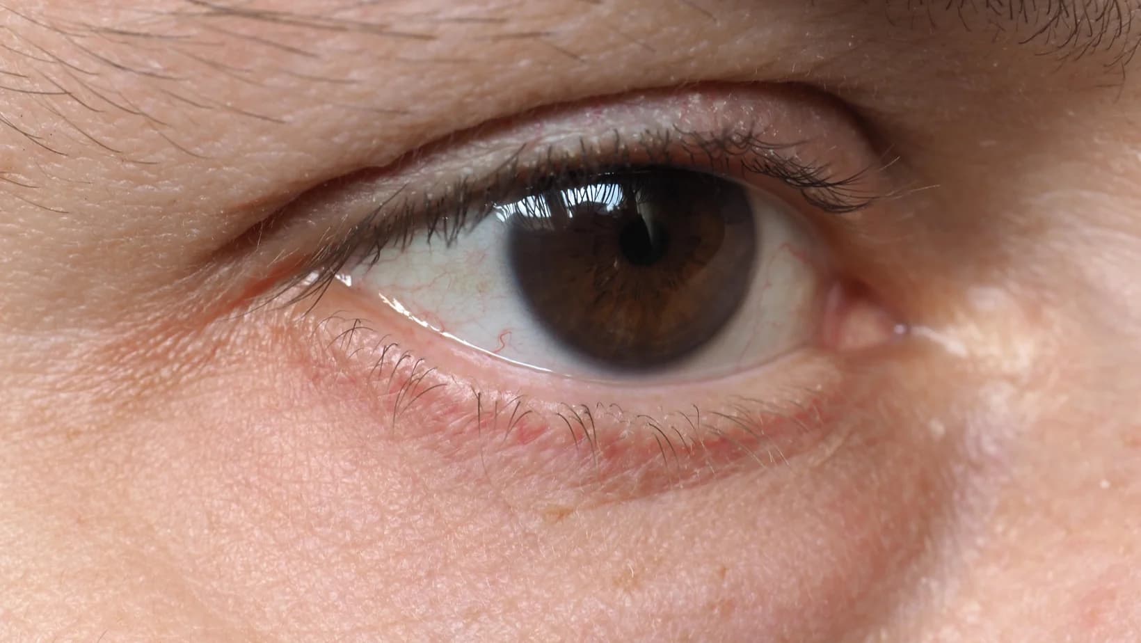 Chirurgia Dacriocistitei: Tratamentul Obstructiei Canalului Lacrimal