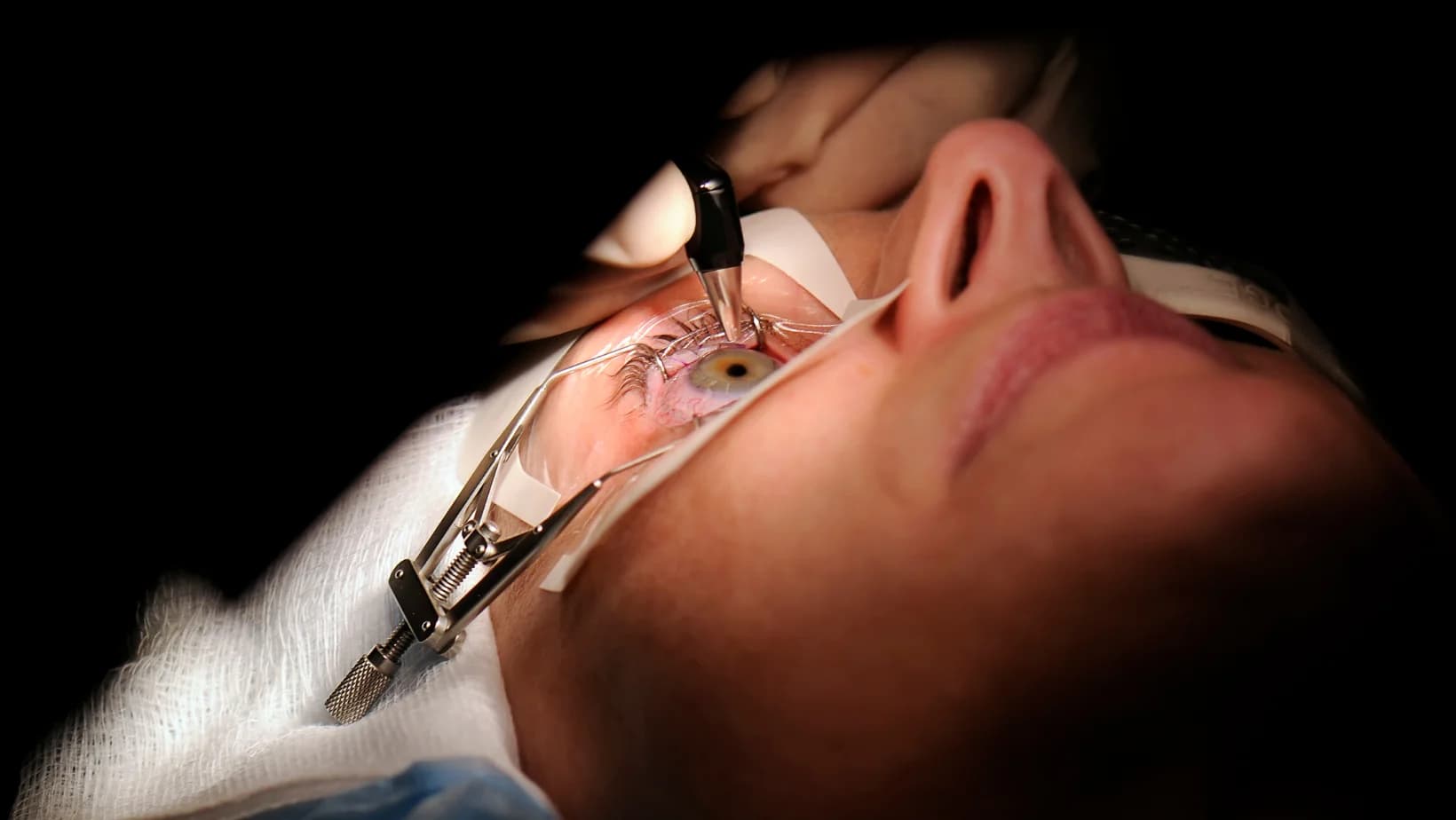 Corectia vederii cu laser: Ce trebuie sa stii despre LASIK si PRK