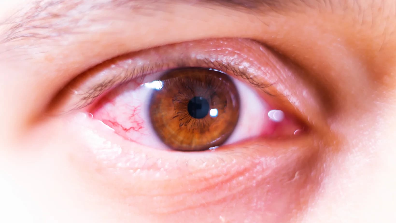 Este Terapia IPL sigura? Cum functionează protectia ochilor in timpul procedurii